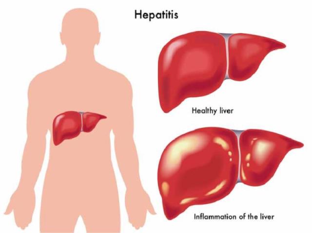 Commentary: Checking The Spread Of Hepatitis