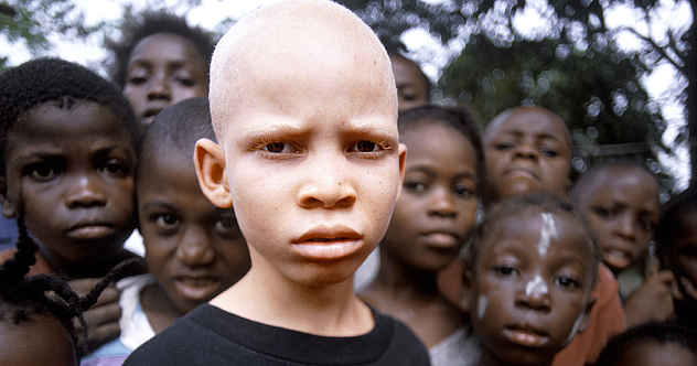 Physiotherapist Ozoekwe  Seeks Protection For Children With Albinism