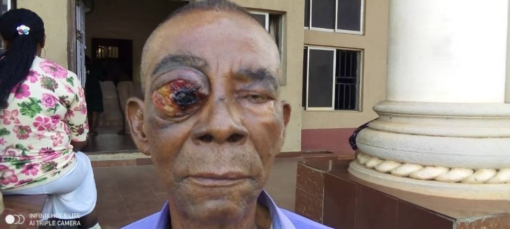 Anambra Journalist John Bosco George Needs  Financial Support To Save Eye From Cancer